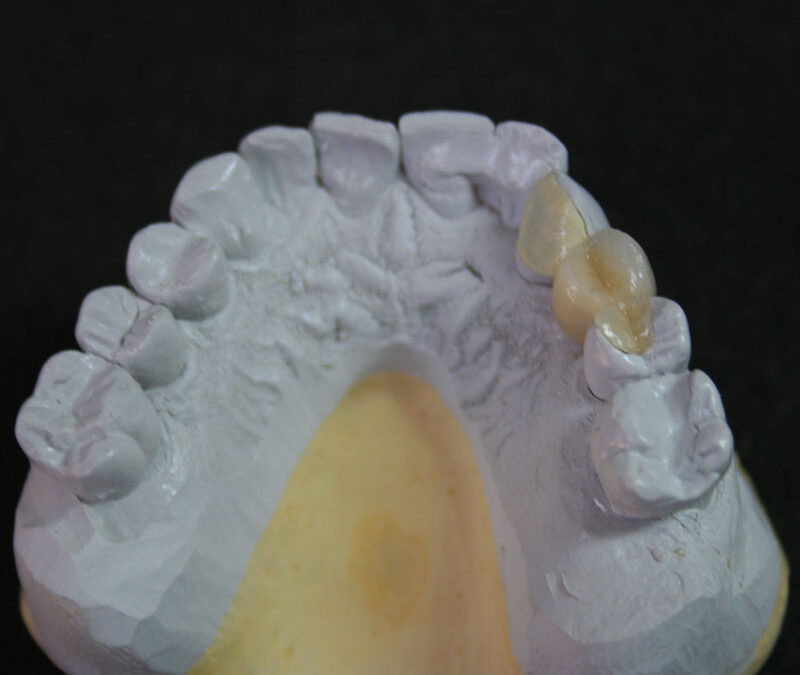 Composito dentale: caratteristiche e vantaggi