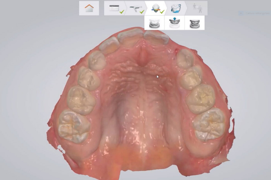 Impronta dentale digitale: precisione e meno disagi per i pazienti