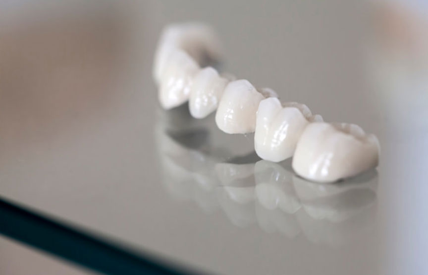 Materiali per corone dentali: i migliori e più affidabili